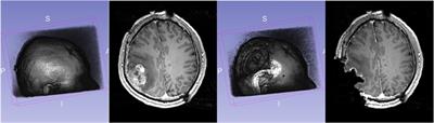 Comparison of physics-based deformable registration methods for image-guided neurosurgery